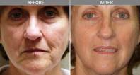 Chicago Laser Skin Tightening